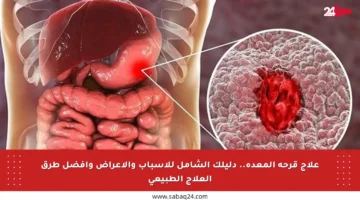 علاج قرحة المعدة.. دليلك الشامل للأسباب والأعراض وأفضل طرق العلاج الطبيعي